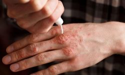 یک بیماری خود ایمن با علائم خارش، قرمزی و ترک‌خوردگی پوست